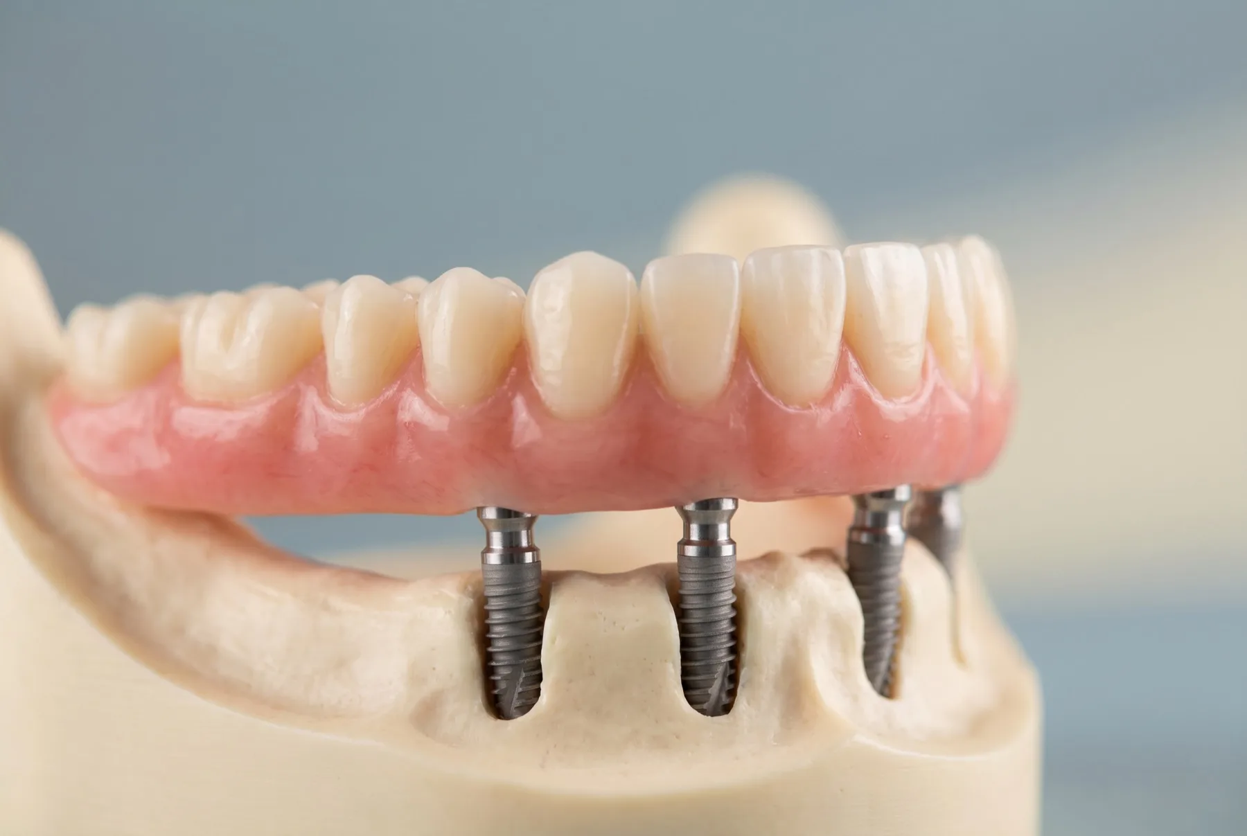 A full arch of teeth supported on four dental implants