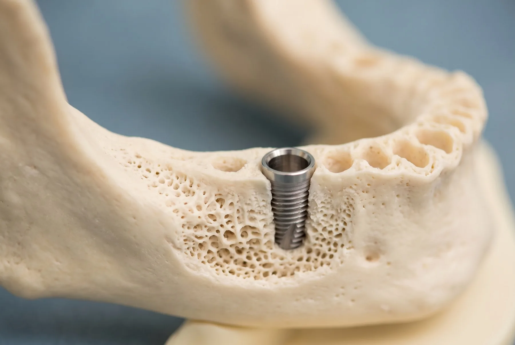 A dental implant placed in rebuilt jawbone